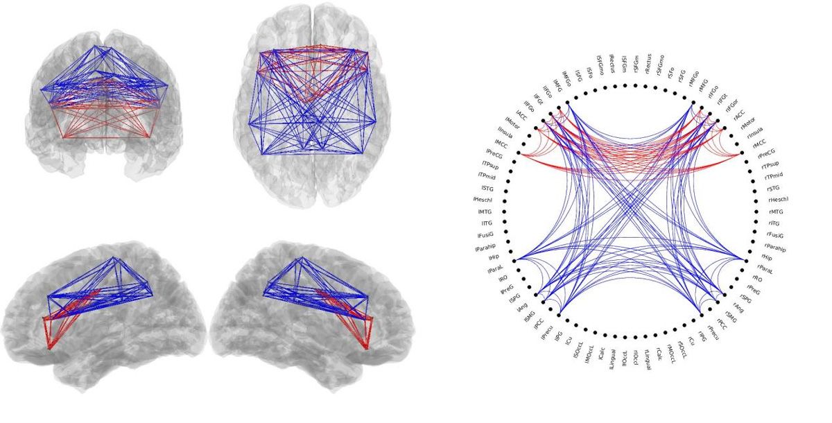 赤と青の線を重ね合わせ、結合性の高い領域と低い領域を示す 4 枚の脳の画像。