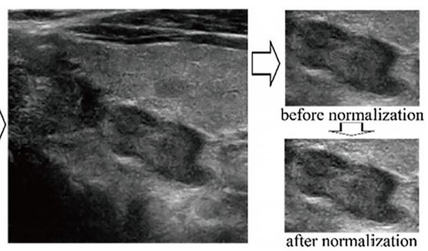 Diagnosis Of Thyroid Nodules From Medical Ultrasound Images With Deep