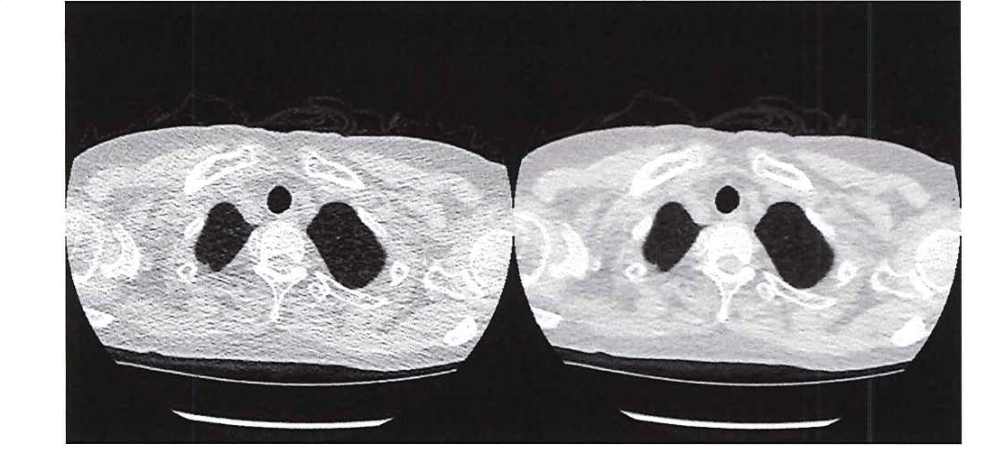 図 1. 超低線量 CT (左) と従来の CT (右) の画質の比較