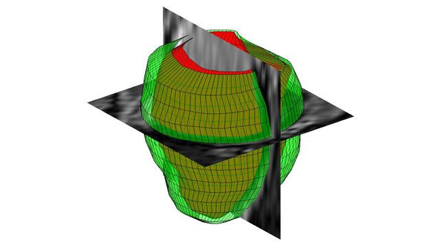 Three dimensional geometrical reconstruction of the human left ventricle from MR images. Three dimensional geometrical reconstruction of the human left ventricle from MR images.
