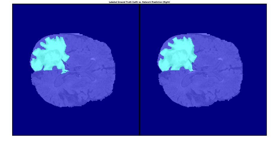 MATLAB とラベル付きグラウンドトゥルース (左) やネットワーク予測 (右) を使用してセグメント化された脳細胞内の腫瘍。