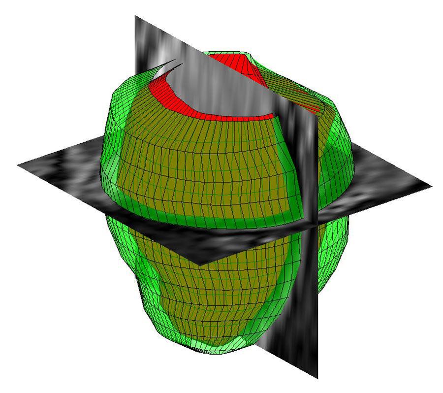 MATLAB により MR 画像から再構築した人間の左心室の 3 次元形状。