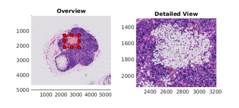 MATLAB の <code>bigimageshow</code> により、腫瘍組織が表示されたリンパ節の画像。