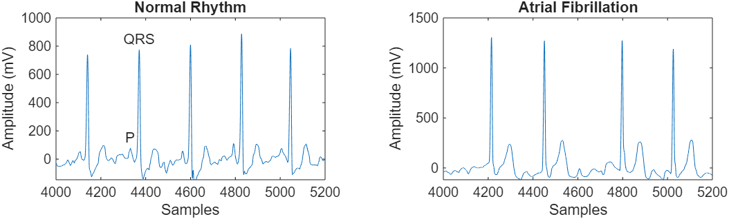 Example plots of ECG signals for normal rhythm and atrial fibrillation. The normal plot has annotations for the QRS and P -wave features.