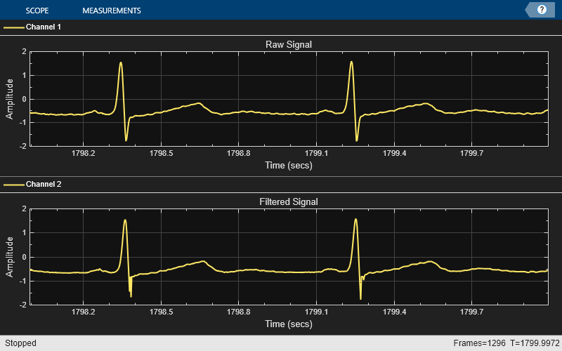 ECG 信号の外れ値を除去する手法