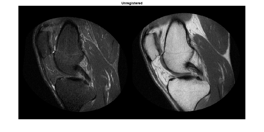 マルチモーダル MRI イメージのレジストレーション