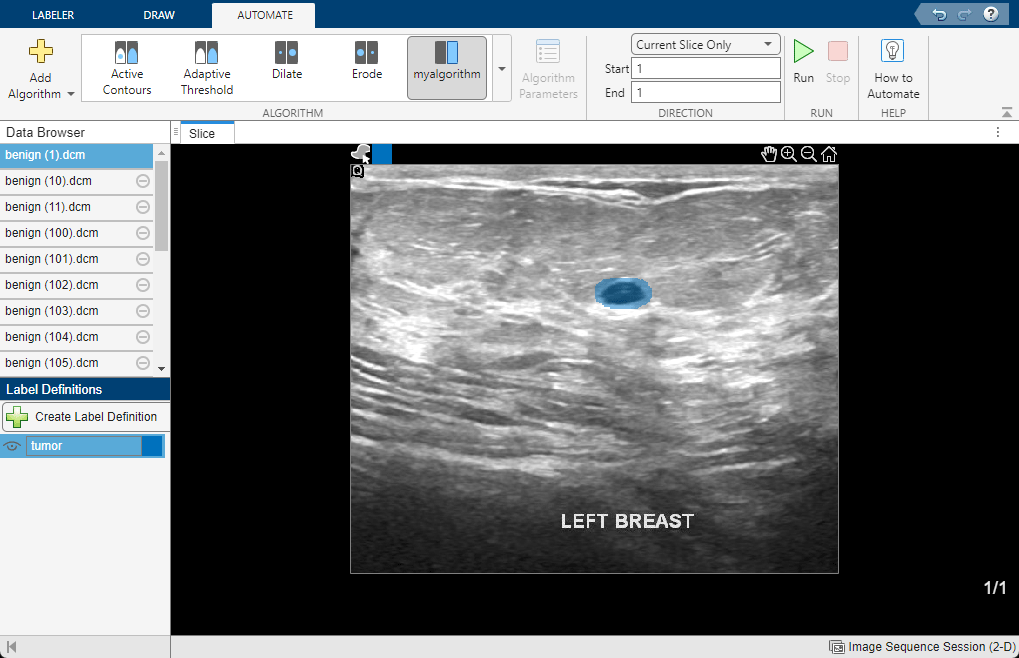 Breast ultrasound image with predicted tumor label mask as an overlay