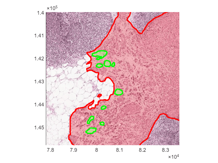 Zoomed in view of tumor region showing tumor boundary in red and normal regions inside the tumor in green
