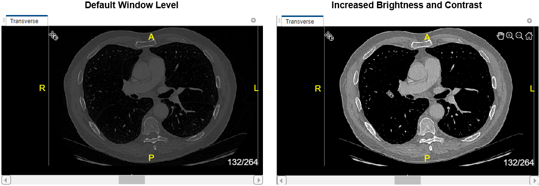 Side-by-side comparison of a transverse CT slice with default window level settings and increased brightness and contrast
