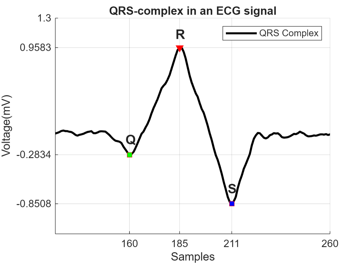 QRS complex in an ECG signal